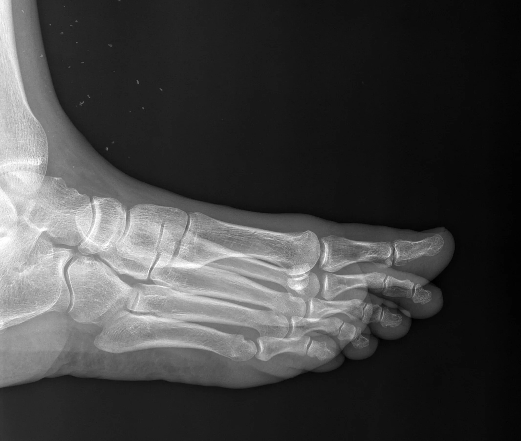Рентген большого пальца стопы. Перелом большого пальца стопы рентген.