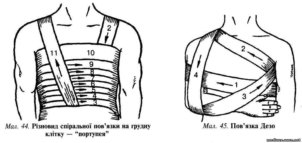 Повязка на грудную клетку алгоритм. Виды повязок на грудную клетку. Спиральная повязка на грудь. Наложение повязки на грудь. Наложение спиральной повязки на грудную клетку.