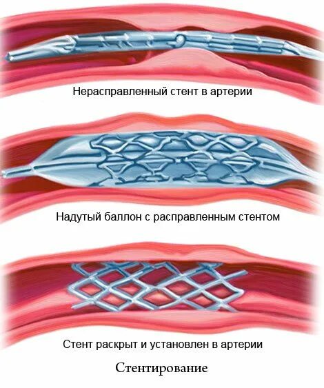 Стентирование артерий. Стентирование позвоночной артерии. Ангиопластика позвоночной артерии.