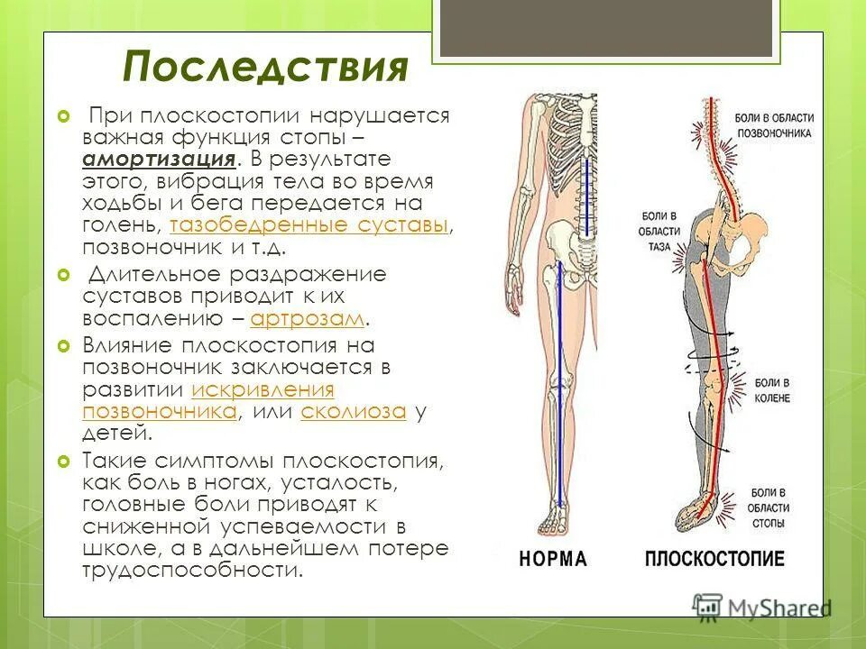 Амортизация скелета. Влияние плоскостопия на позвоночник. Последствия плоскостопия. Влияние плоскостопия на организм. Осложнения плоскостопия.