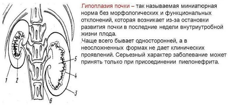 Уменьшение размеров почки. Врожденная гипоплазия почки. гипоплазия почки по узи. гипотрофия и гипоплазия почки. гипо аплазия левой почки.