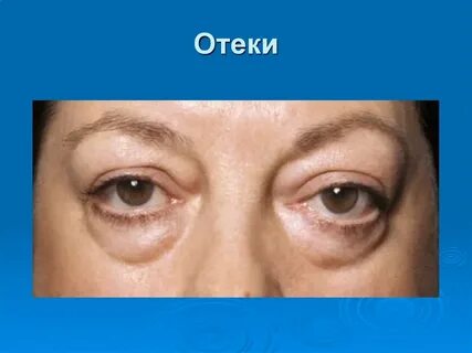 Чувство отека