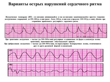 Острые нарушения ритма