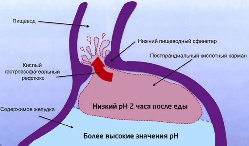 После низком. Кислотный карман желудка. Постпрандиальный кислотный карман. Кислотный карман при ГЭРБ.