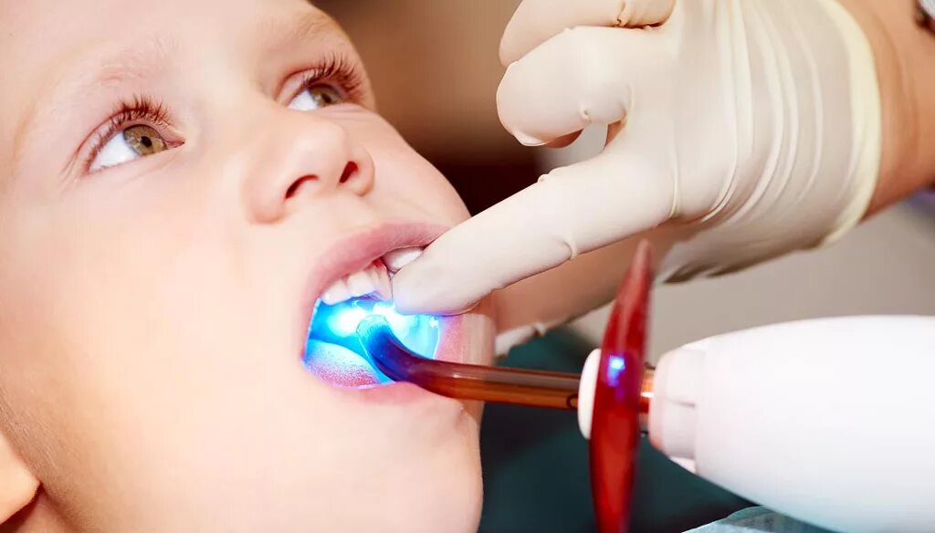 Пломбы детям на молочные зубы. Пломбы детям на молочные зубы. Герметик для фиссур. Кариес зубов детская стоматология. Материал для пломб детей.