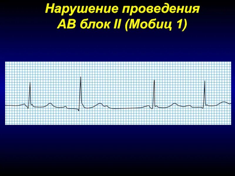 Av блок. Мобиц. Мобиц 1. Мобиц 2. Мобиц 1 и Мобиц 2 на ЭКГ различия.