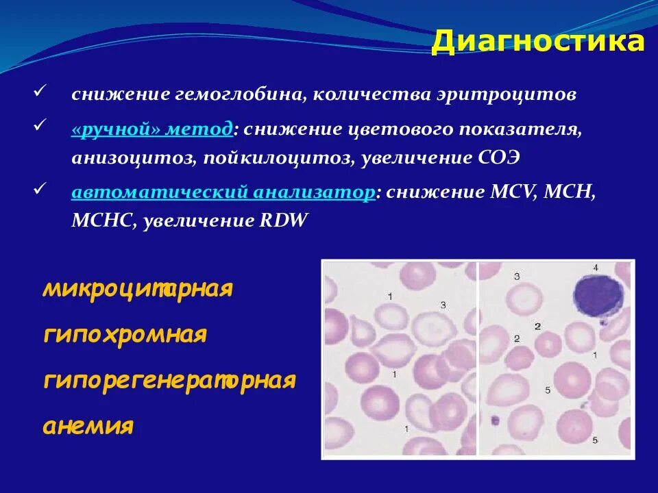 Гипохромия эритроцитов. Железодефицитная анемия гипохромная микроцитарная. анемия микроцитарная гипорегенераторная. анизоцитоз и пойкилоцитоз. анизоцитоз пойкилоцитоз гипохромия.