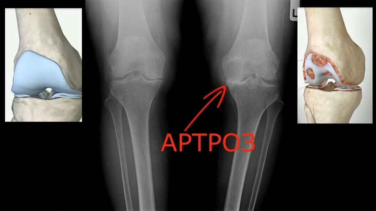 Артроз коленного сустава название. Деформирующий артроз 1 степени. Деформирующий остеопороз коленного сустава. Деформирующий артроз 2 степени. Деформ артроз коленного сустава.