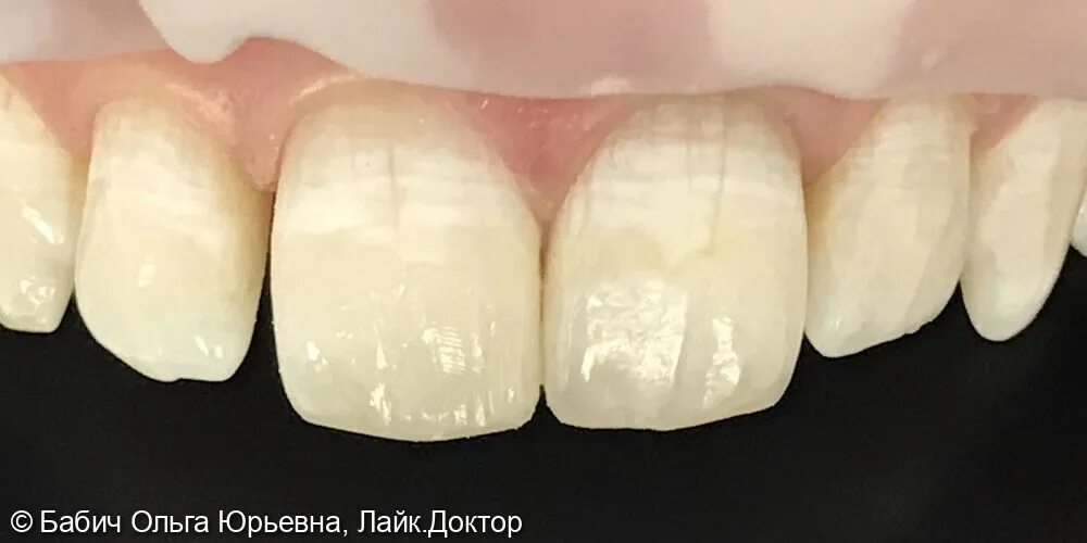 Внутреннее отбеливание