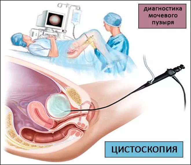 Цистоскопия мочевого пузыря у женщин как делают. Цистоскопия мочевого пузыря у женщин как делают