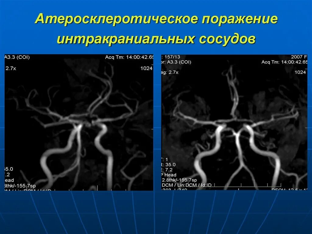 Сосуды головного мозга норма. Кт ангиография интракраниальных артерий. Интракраниальные артерии головного мозга. Кт ангиография сонных артерий. МР-ангиография интракраниальных сосудов.