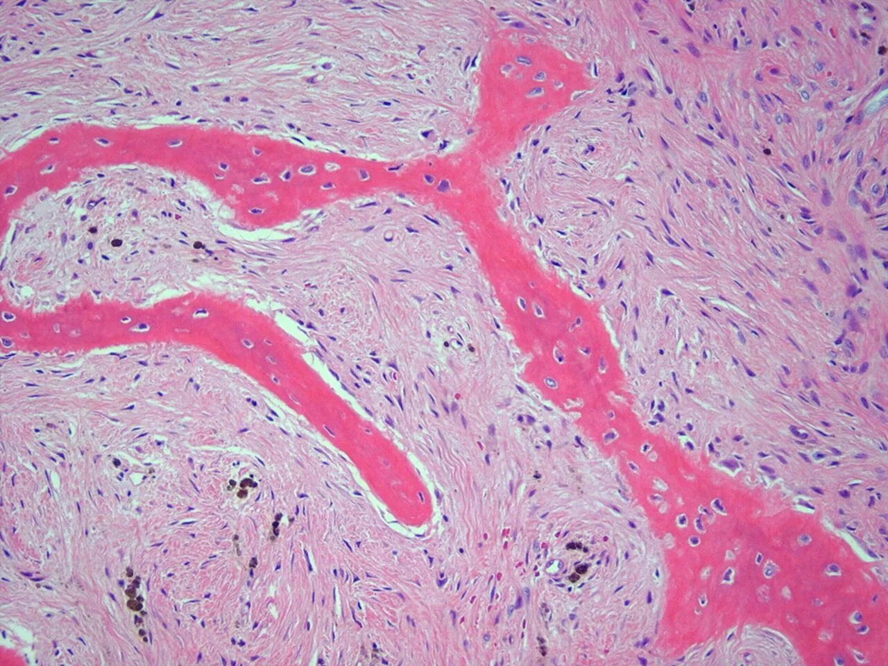 Алкогольный монолобулярный цирроз печени микропрепарат. Стеатогепатит гистология. Фиброзная остеодисплазия гистология. Гистологические стадии фиброза печени. Гипертрофический цирроз печени гистология.