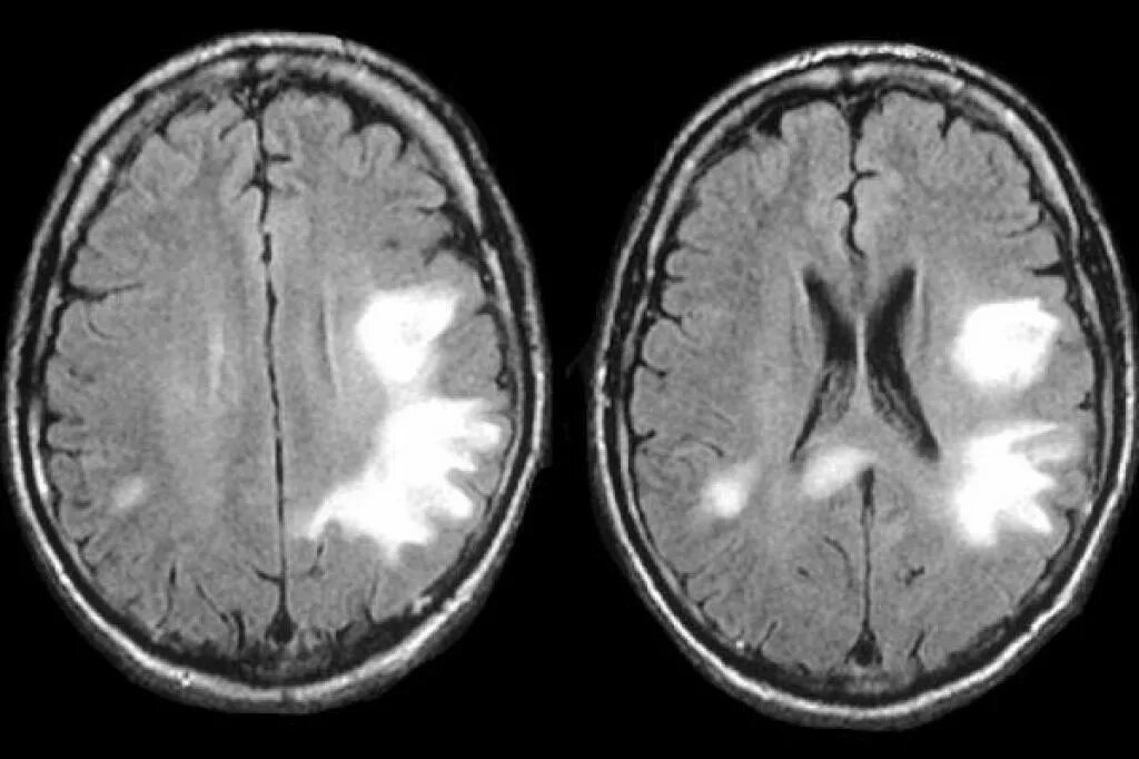 Очаги сосудистого генеза головного мозга что это. Прогрессирующая мультифокальная лейкоэнцефалопатия мрт. Мультифокальная лейкоэнцефалопатия кт. Прогрессирующая сосудистая лейкоэнцефалопатия. Лейкоэнцефалопатия головного мозга сосудистого генеза.