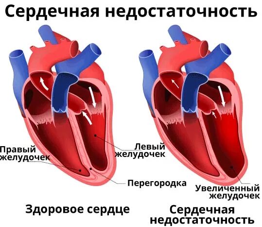 Недостаточность предсердия. Сердечная недостаточность. Сердечный недостаточность. Серная недостаточность. Острая и хроническая сердечно-сосудистая недостаточность.