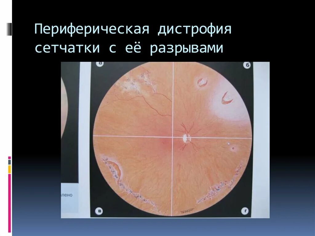 Периферические ретинальные дегенерации. Решетчатая дистрофия сетчатки глаза. Перипапиллярная дистрофия сетчатки. Решетчатая дегенерация сетчатки. Инееподобная дегенерация сетчатки.