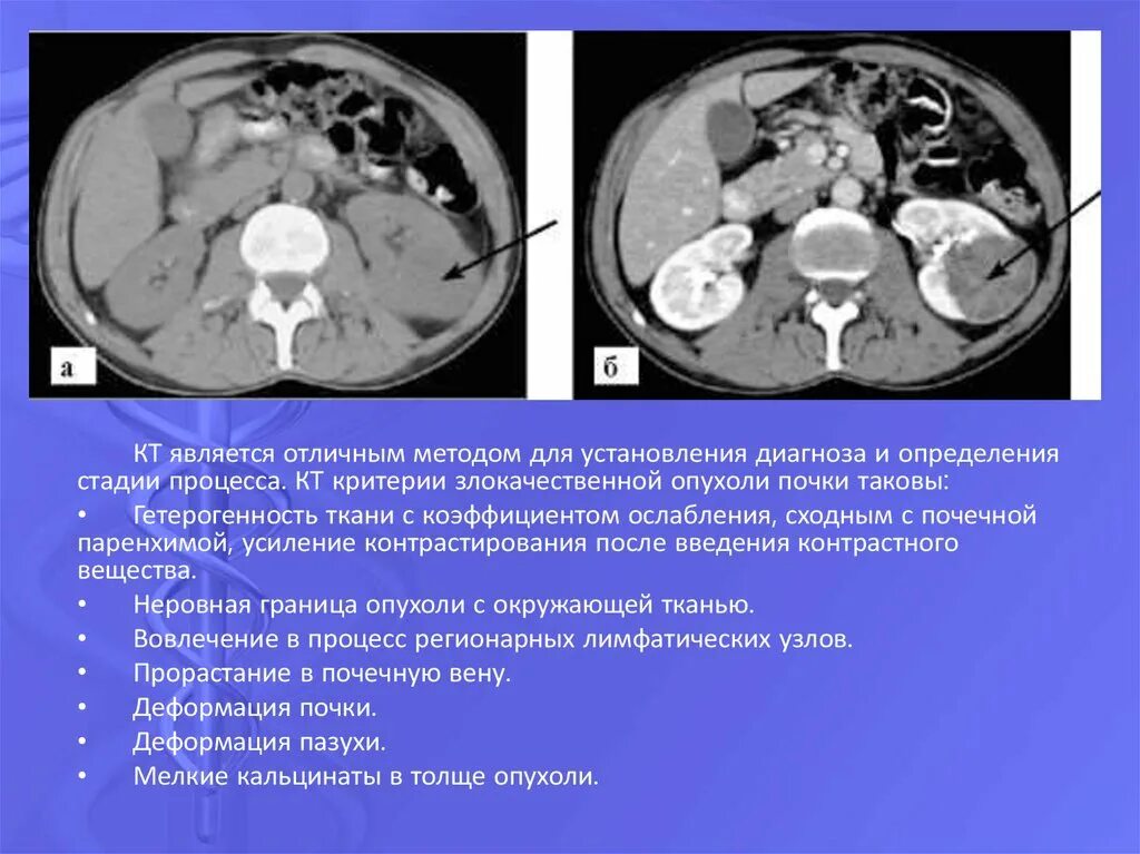 Светлоклеточная карцинома почки кт. Кт с контрастированием опухоль почки. Объемные образования почек кт.