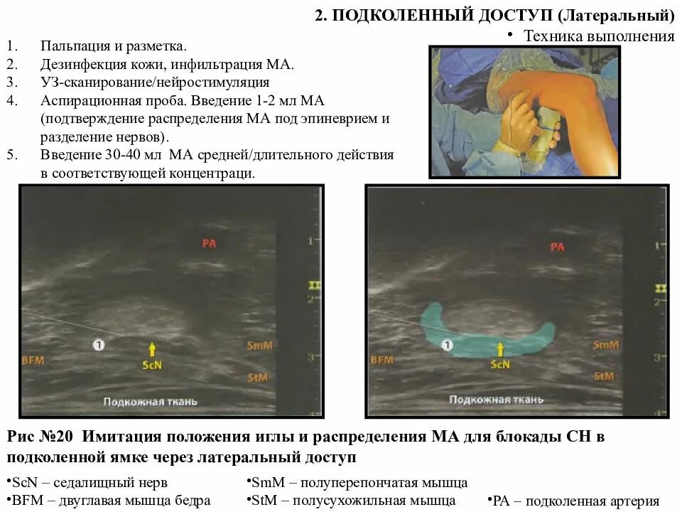 Блокада под узи. Блокада седалищного нерва подколенным доступом. Блокада подколенного нерва. Проводниковая блокада седалищного нерва. Блокада седалищного нерва показания.