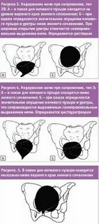 Что такое цистоцеле у женщин