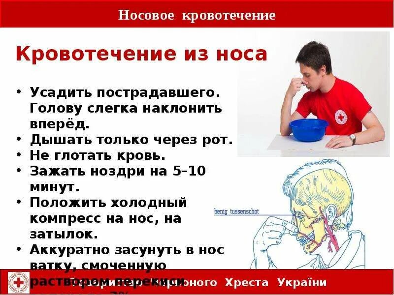 Кровотечение у взрослых. Сильное носовое кровотечение. если идёт кровь из носа. холодный компресс при носовом кровотечении.