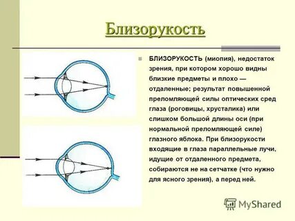 Осевая миопия