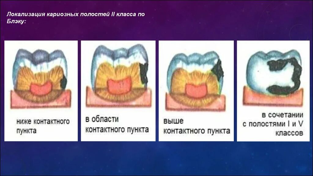 Классы полости рта. Кариес зубов классификация кариозных полостей по Блэку. Кариозные полости 2 класса по Блэку. Классификация Блеку кариеса. Локализация кариеса 2 класса.