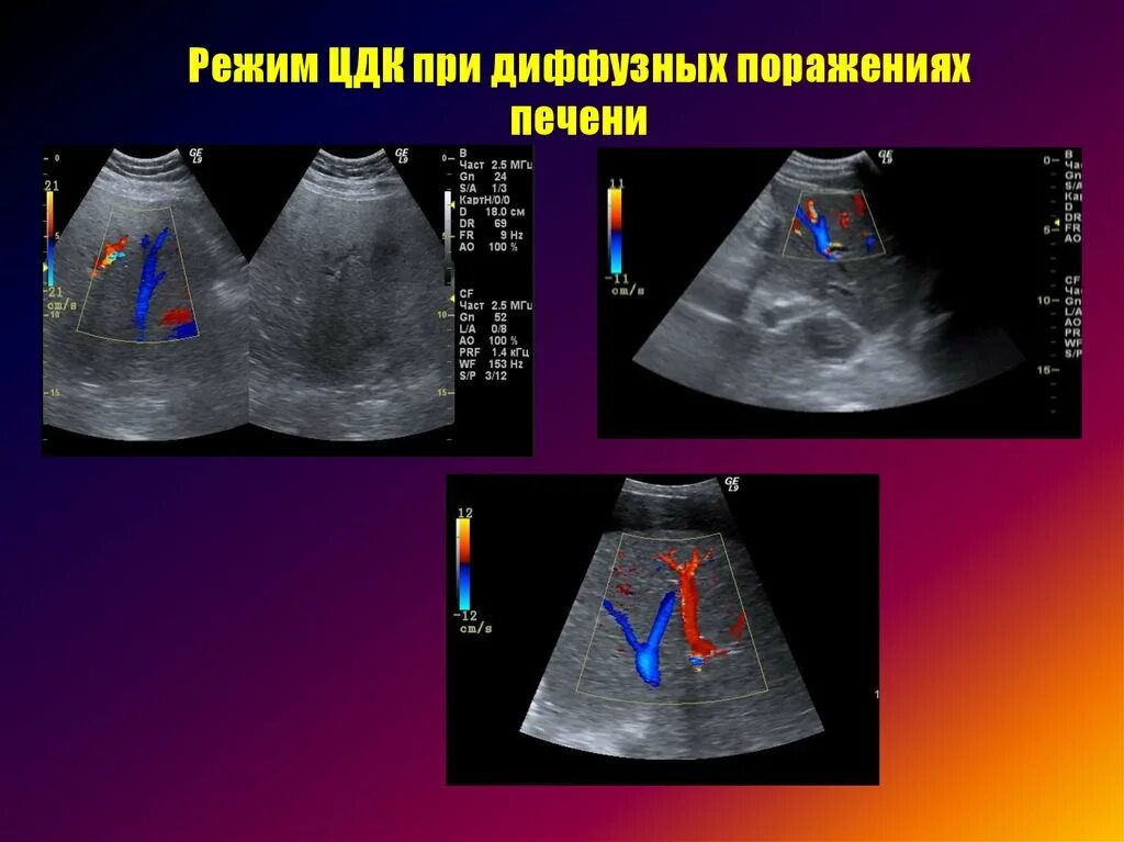 Диффузная печень форум. Ультразвуковая диагностика печени. Диффузные заболевания печени лучевая диагностика. Токсическое поражение печени на УЗИ. Диффузные заболевания печени УЗИ.