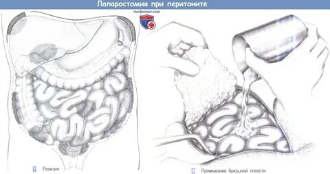Лапаротомия ревизия