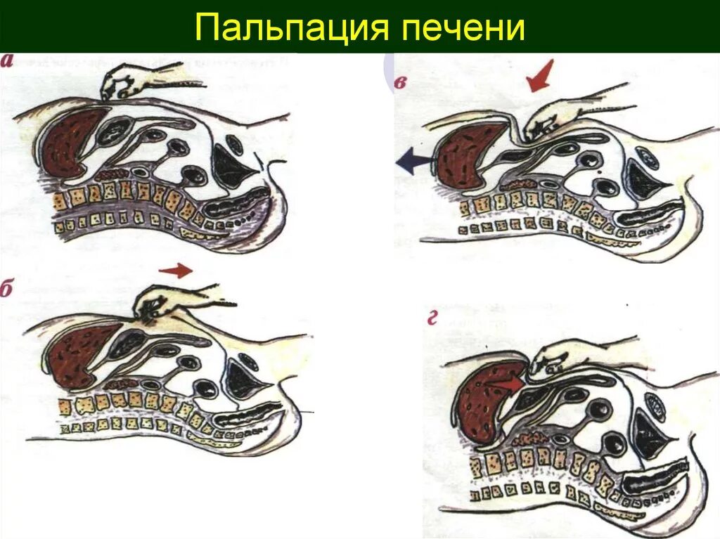 Край печени пальпируется. Заключение при пальпации печени. Край печени при пальпации.