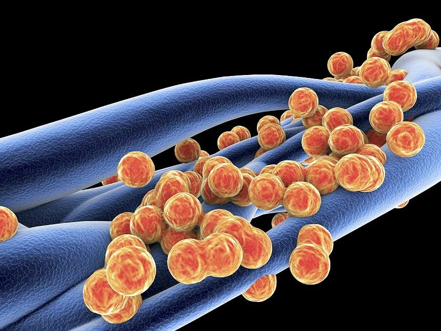 Метициллин резистентный золотистый. Золотистый стафилококк MRSA. Метициллин-резистентный золотистый стафилококк. Prsa стафилококки. S. aureus золотистый стафилококк.