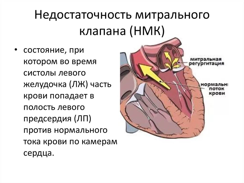 Недостаточность митрального клапана 1. Недостаточность митрального клапана 2 степени сердце. Недостаточность митрального клапана структура. Пороки сердца недостаточность митрального клапана. Сердечная недостаточность митрального клапана