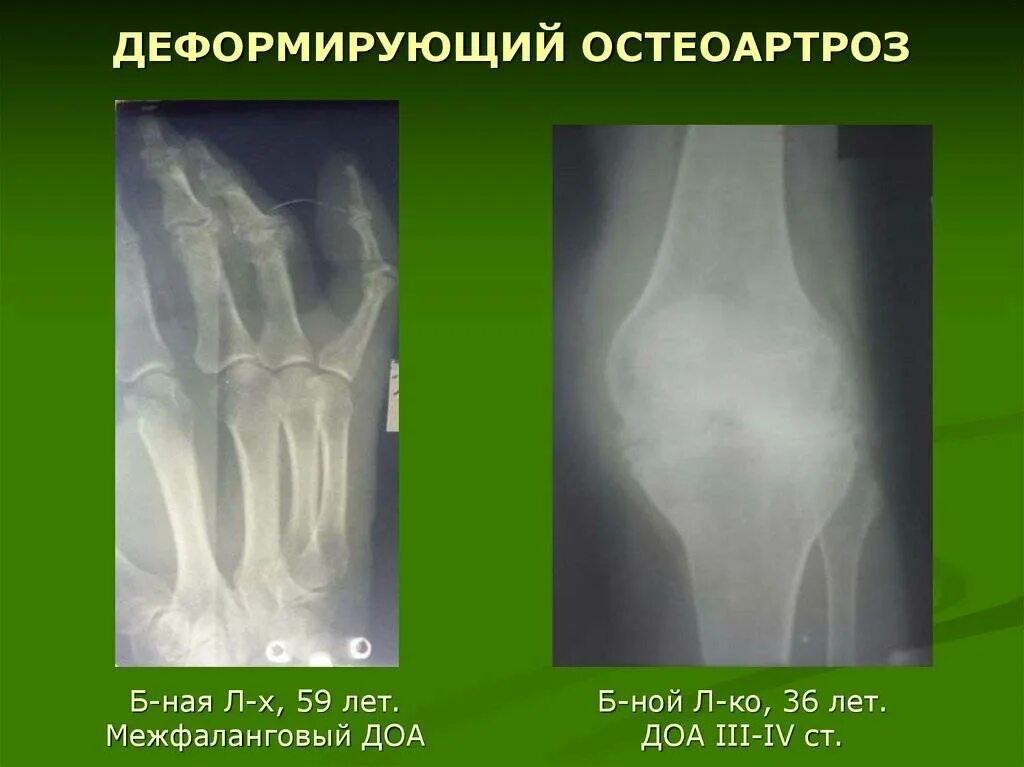 Деформирующий остеоартроз степени рентген. Доа коленных суставов 3 ст рентген. Деформирующий остеоартроз 2 степени.
