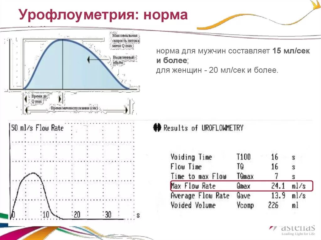 Урофлоуметрия нормальная кривая. Урофлоуметрия при гиперактивном мочевом пузыре. Урофлоуметрия показатели нормы у мужчин. Урофлоуметрия расшифровка показателей.