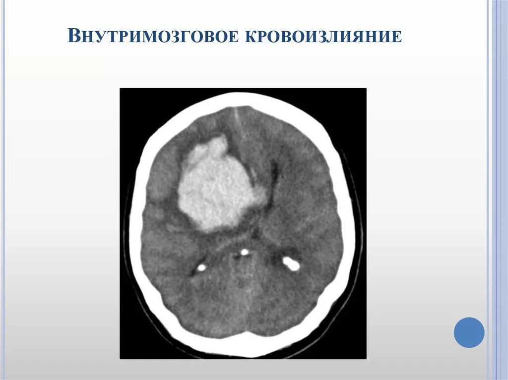 Субкортикальное внутримозговое кровоизлияние. Внутримозговое (паренхиматозное) кровоизлияние. Внутримозговое кровоизлияние кт.