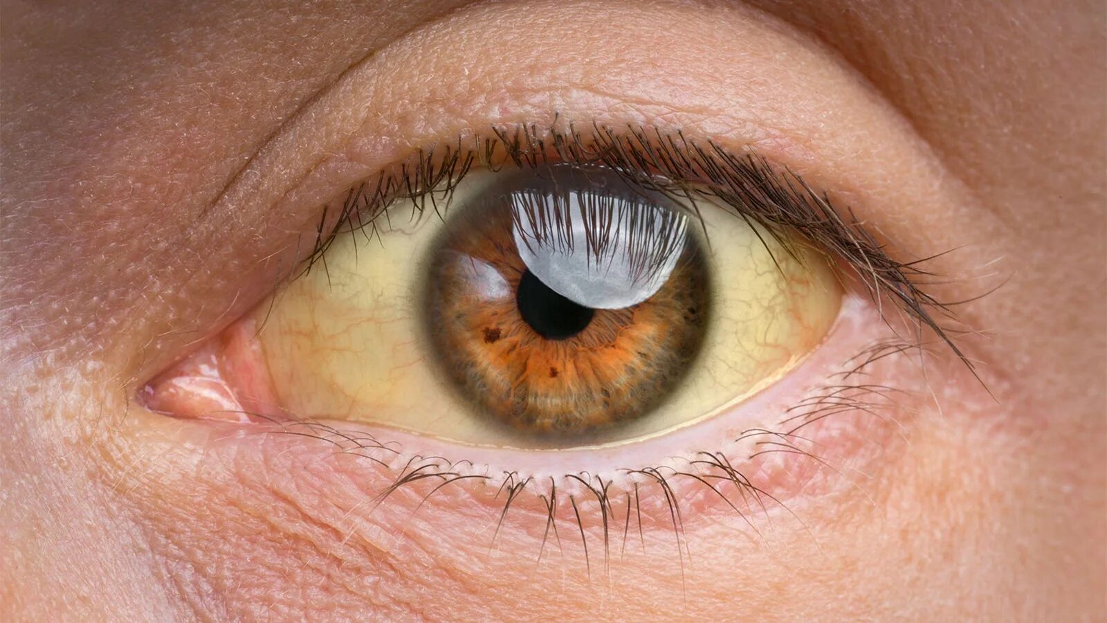 Желтый глаз 13. Пожелтение склер гепатит. Синдром Жильбера склеры.