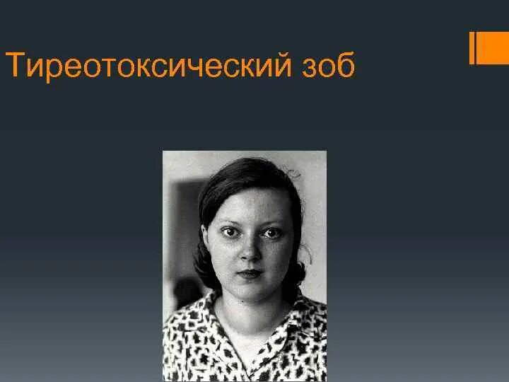 Тиреотоксический зоб. Диффузный тиреотоксический зоб. Тиреотоксический зоб картинки. Диффузный токсический зоб (базедова болезнь).