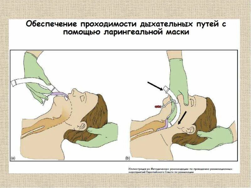 Обеспечение проходимости дыхательных путей. Обеспечить проходимость дыхательных путей. Обеспечить проходимость верхних дыхательных путей. Обеспечение проходимости верхних дыхательных путей при реанимации. Проверка проходимости дыхательных путей