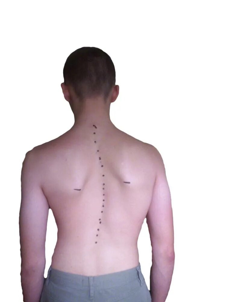 искривление позвоночника 17