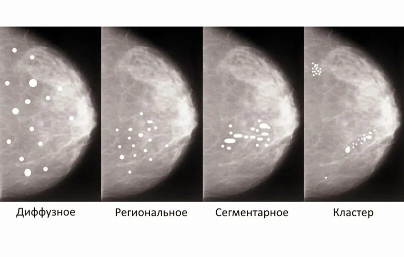 Округлые кальцинаты