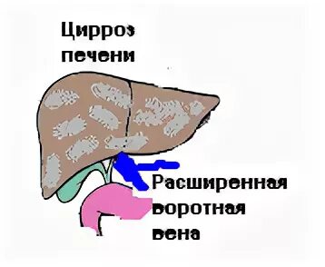 Обедненный рисунок печени