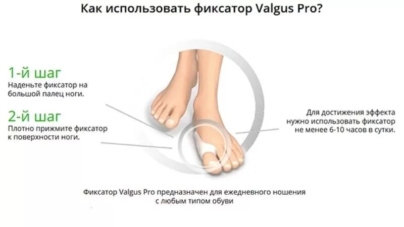 Фиксатор "valgus Pro" (вальгус про). Фиксатор вальгус про для большого пальца ноги. Нормальное положение большого пальца стопы. Valgus Pro фиксатор для большого пальца ноги.