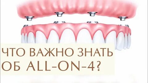 Все на 4 имплантах отзывы форум