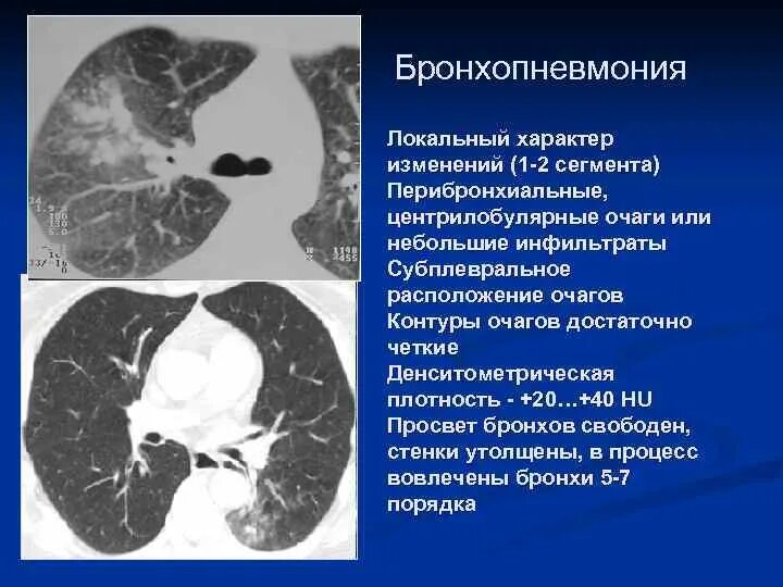 Дерева в почках в легких кт. Очаговая бронхопневмония кт. Бронхогенная пневмония на кт. Перибронхиальная инфильтрация легких на кт. Очаговая инфильтрация легких кт.