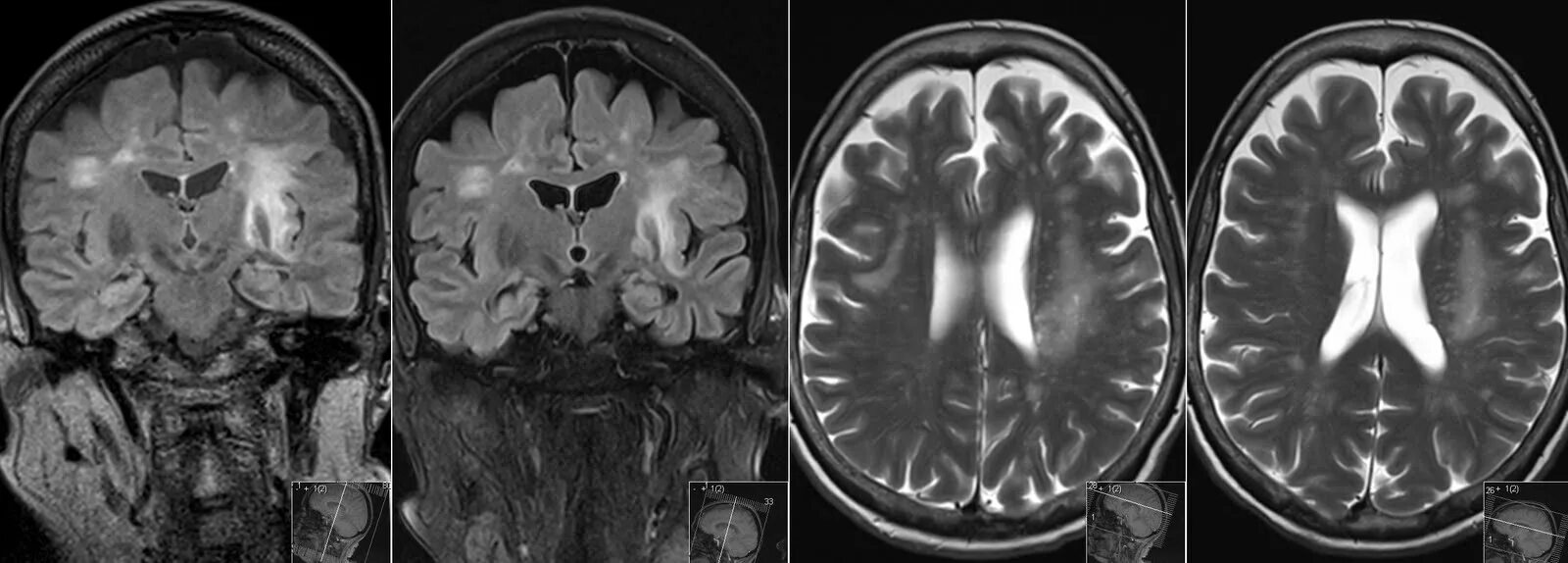 Болезнь Альцгеймера кт и мрт. Мультифокальная лейкоэнцефалопатия мрт. Мультифокальная лейкоэнцефалопатия кт. ПМЛ мрт прогрессирующая мультифокальная лейкоэнцефалопатия. Диффузная атрофия головного мозга