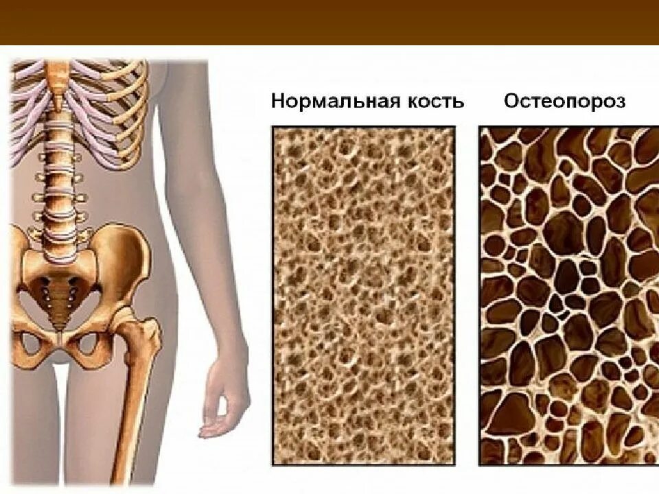 Нормальная кость и остеопороз. Нормальная кость и кость с остеопорозом. Остеопороз тазобедренного сустава.