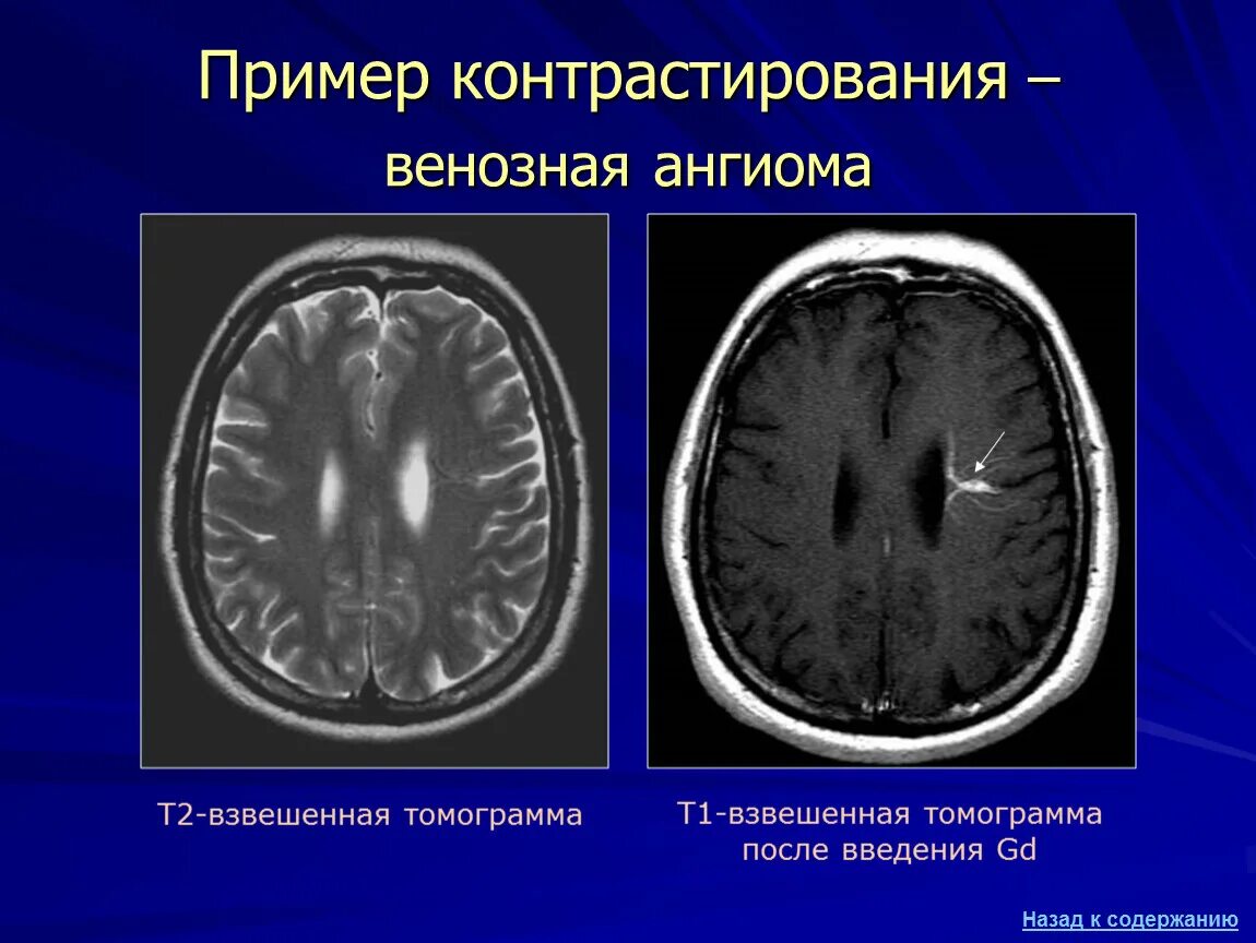 Венозная дисплазия головного мозга кт. Венозная ангиома головного мозга кт. Венозная ангиома головного мозга мрт. Ангиома правой лобной доли