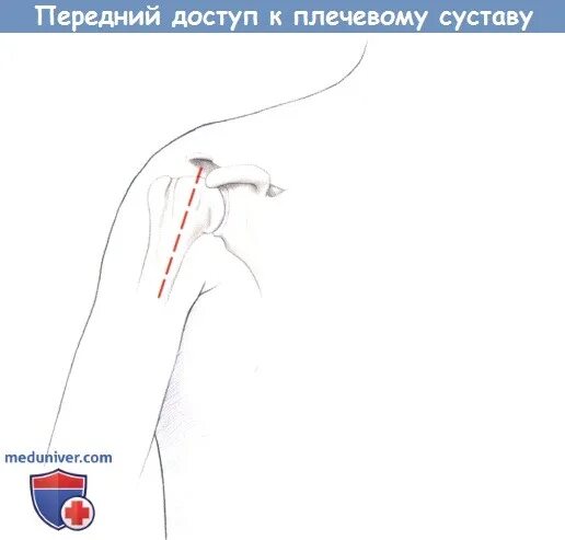 Краевая резекция кости бедренной кости. Артротомия плечевого сустава топографическая анатомия. Импрессионный дефект головки плечевой кости. Резекция плечевой кости. Перелом мвщелка лучевой кости.