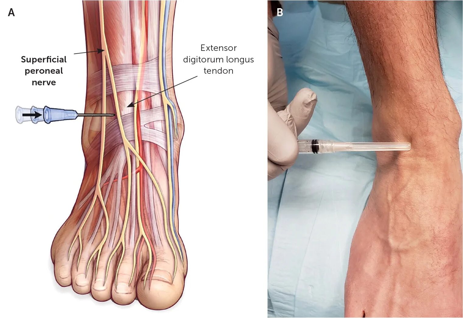 Superficial Peroneal nerve. Deep Peroneal nerve. Нейропатия операция