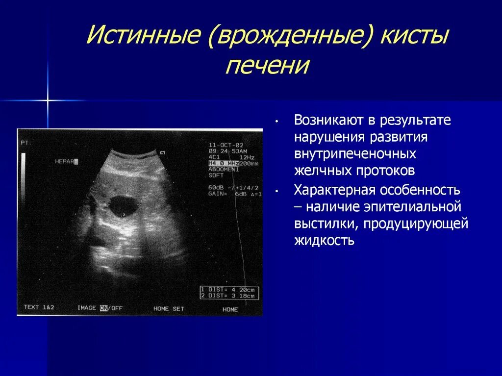 Киста печени у взрослых. Врожденные кисты печени. Кисты печени клинические рекомендации.