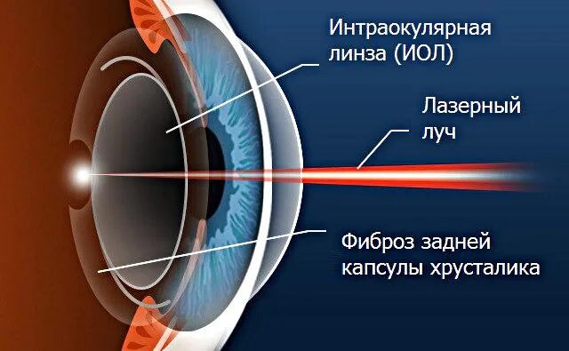 Вторичная пленчатая катаракта. Вторичная катаракта лазерная капсулотомия. Лазерная yag дисцизия вторичной катаракты. Лазерная дисцизия вторичной катаракты. Лазерная дисцизия вторичной катаракты.