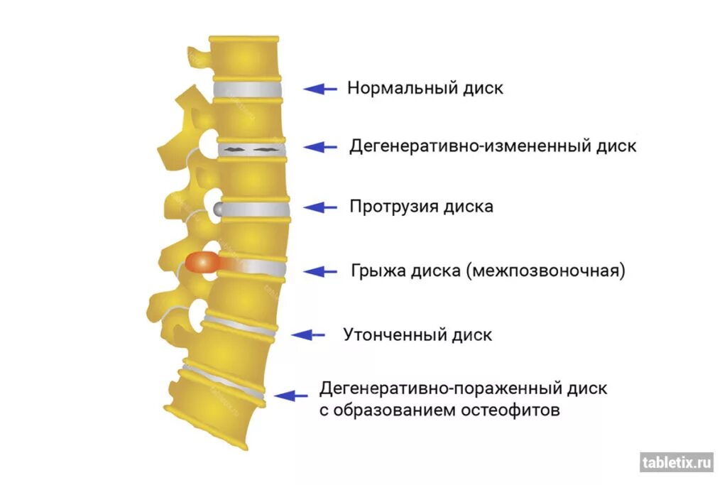Сколько лечится позвоночник. Протрузия позвонков поясничного отдела. Протрузия межпозвонковых дисков крестцового отдела. Протрузия диска th1/th2. Протрузии диска грудного отдела позвоночника.